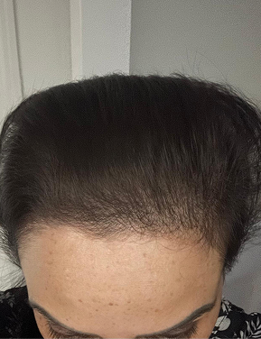 Hair after treatment